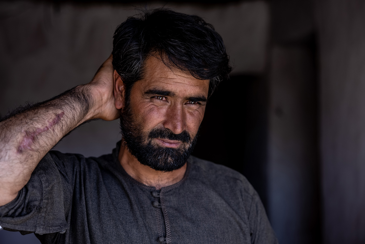 Un hombre muestra las heridas de un ataque de mortero en Afganistán.